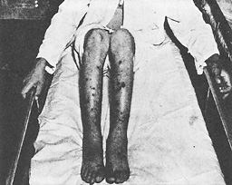 Salt water caused these sores